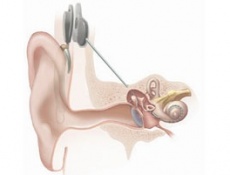 Как в ФРГ лечат полную глухоту: кохлеарные имплантаты